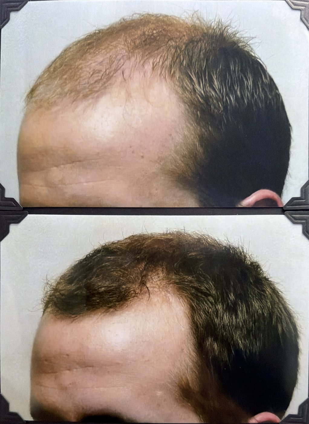 Before and after hair restoration result 7