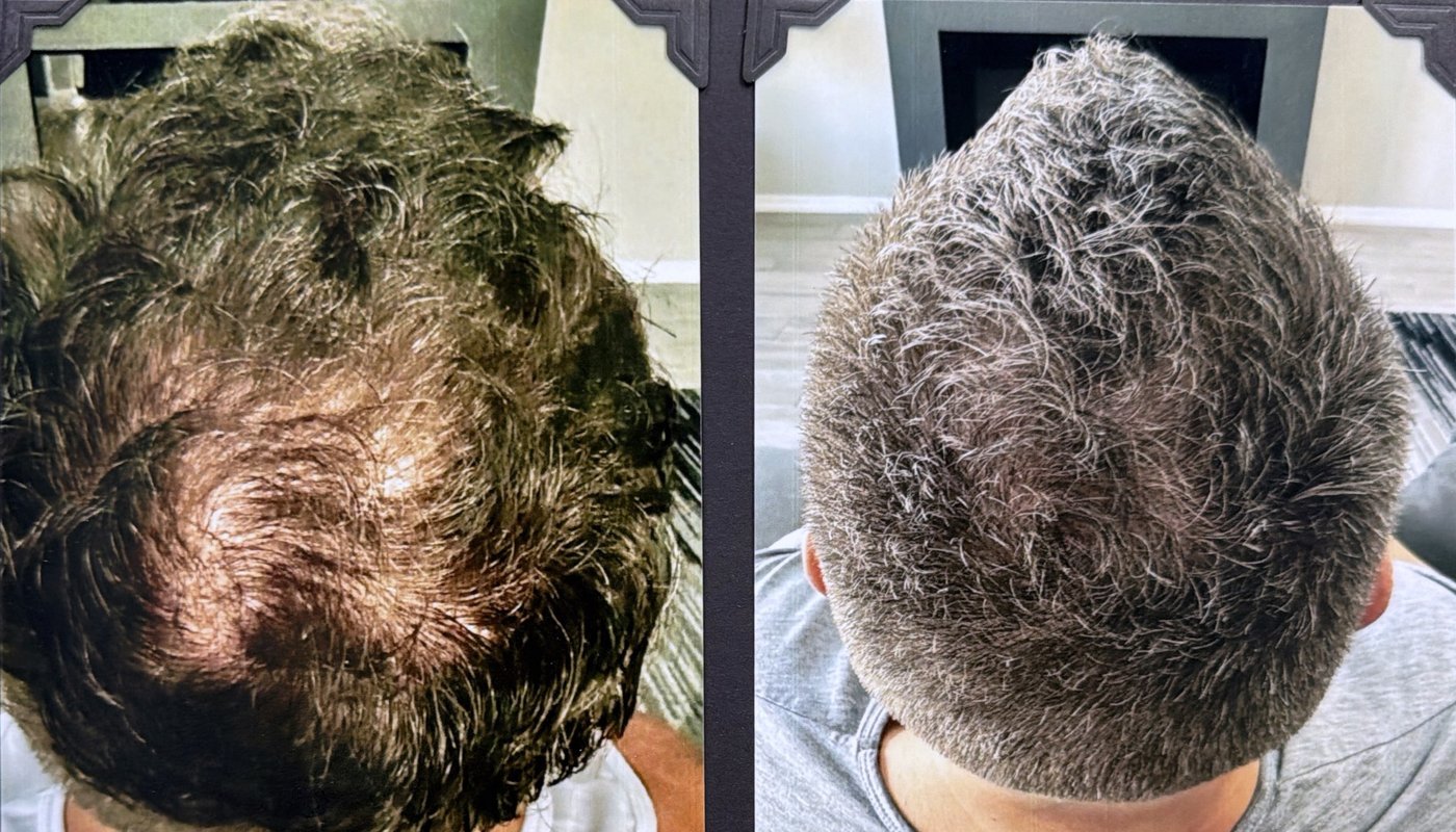 Before and after hair restoration result 9