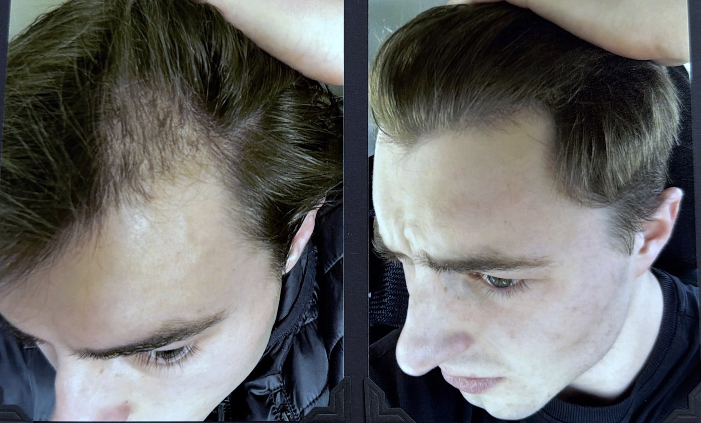Before and after hair restoration result 11
