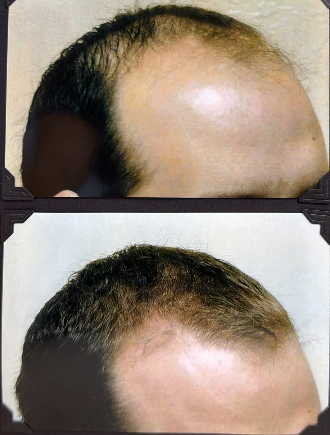 Before and after hair restoration result 12