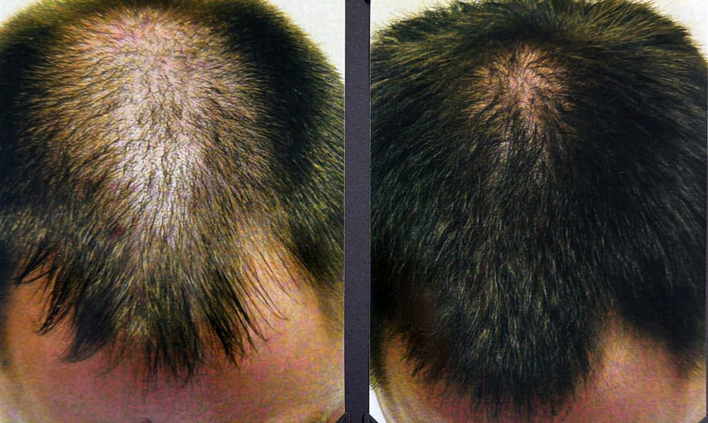 Before and after hair restoration result 21