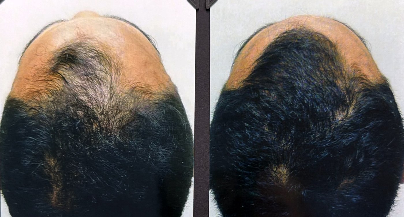 Before and after hair restoration result 23