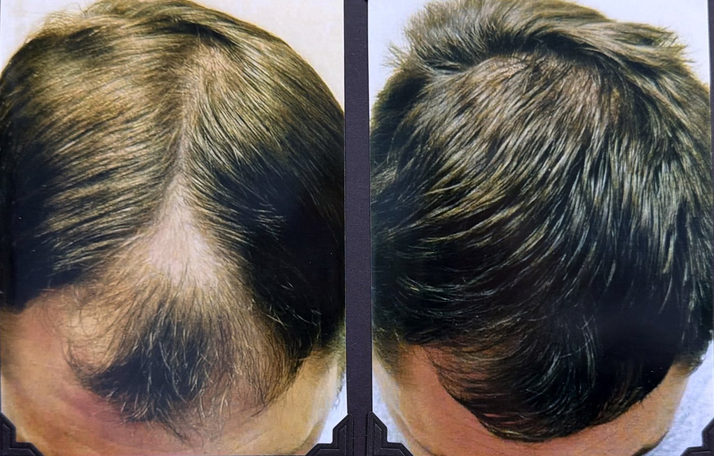Before and after hair restoration result 25